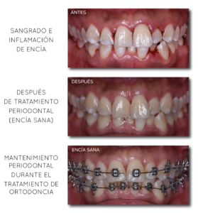 SANGRADO E INFLAMACION DE ENCIA-27